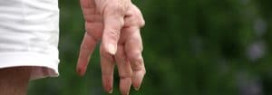 arthritis affecting fingers